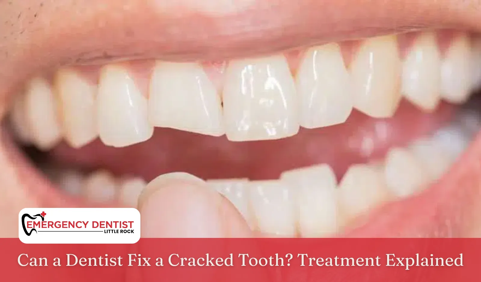 Can a Dentist Fix a Cracked Tooth Treatment Explained
