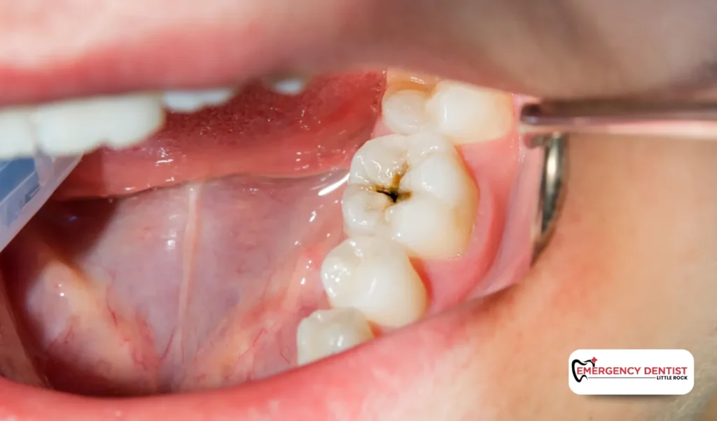 Recognizing the Symptoms of a Cracked Tooth
