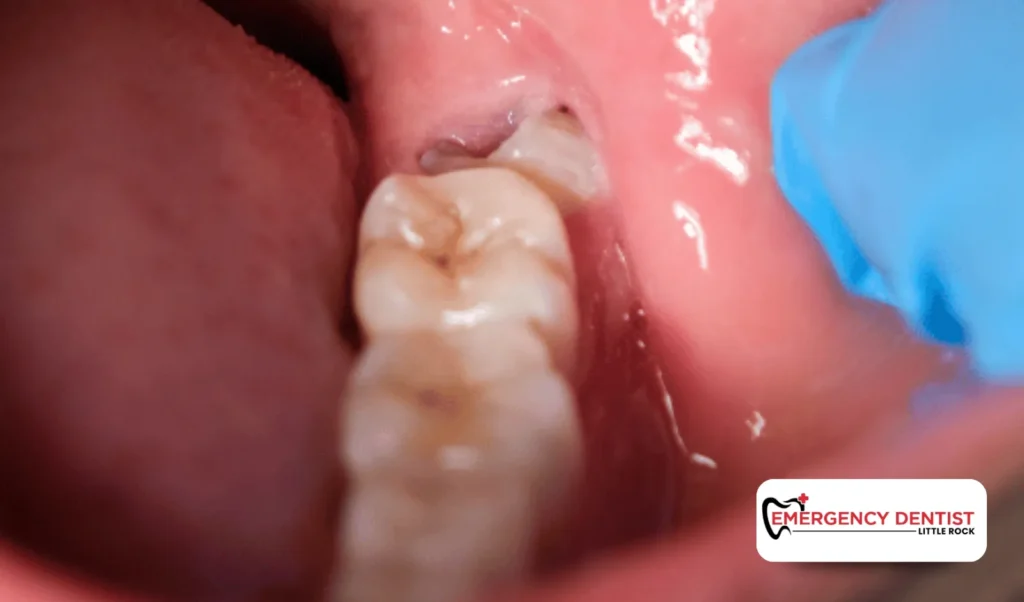 Tooth Infection Pain and Abscess Tooth Pain