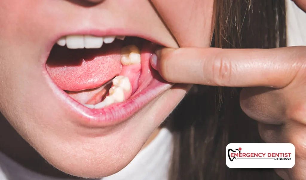 Tooth Pain After Tooth Pulled Normal Healing or Dry Socket