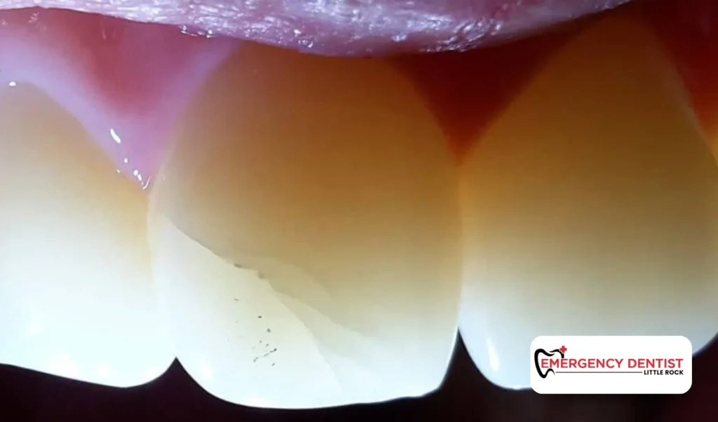 Understanding Cracks in Front Teeth