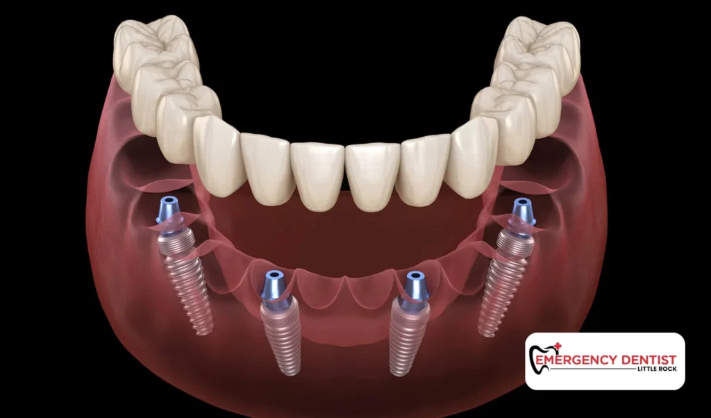 Considering Dental Implants After Tooth Removal