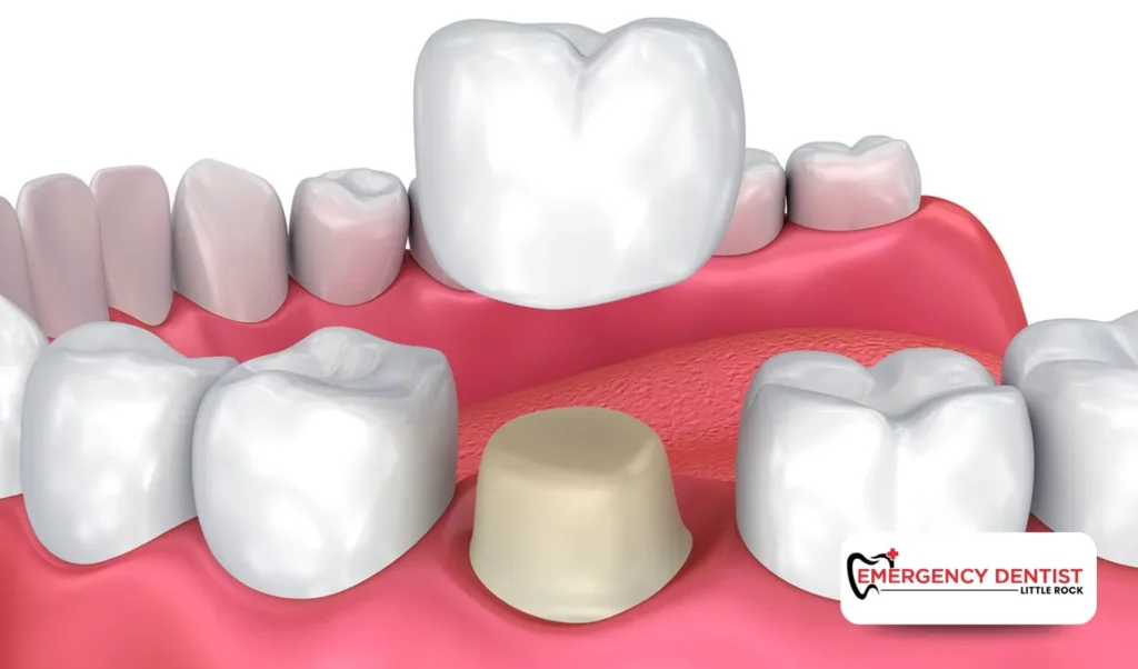 Dental Crowns