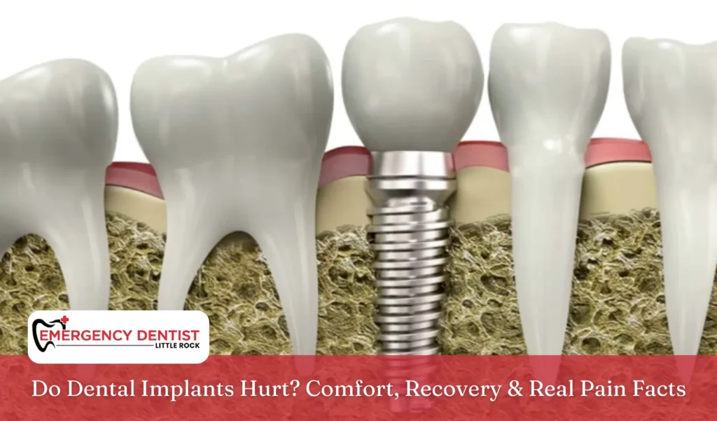 Do Dental Implants Hurt Comfort, Recovery & Real Pain Facts
