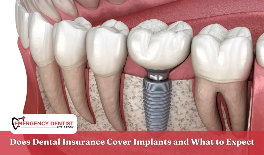 Does Dental Insurance Cover Implants and What to Expect