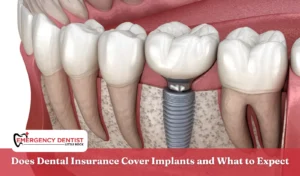 Does Dental Insurance Cover Implants and What to Expect