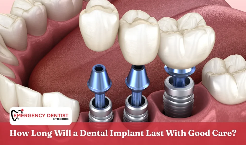 How Long Will a Dental Implant Last With Good Care