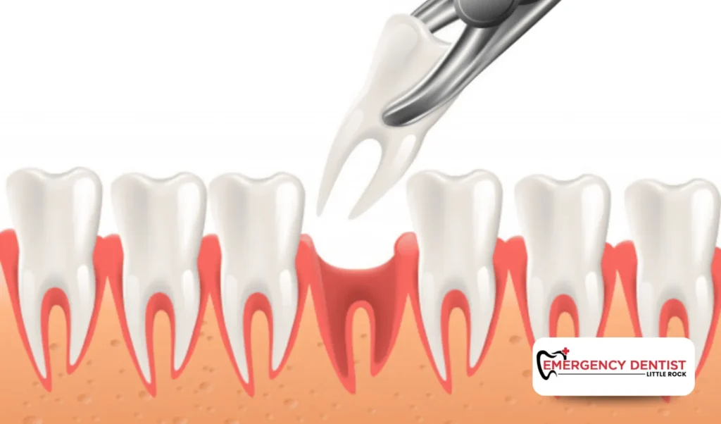Types of Tooth Extractions