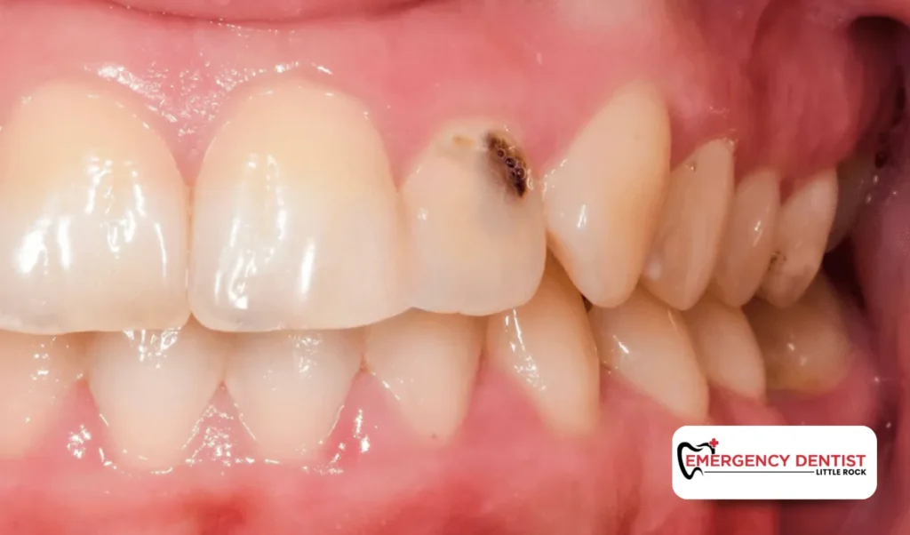 What Causes Root Canal Treatment to Be Necessary