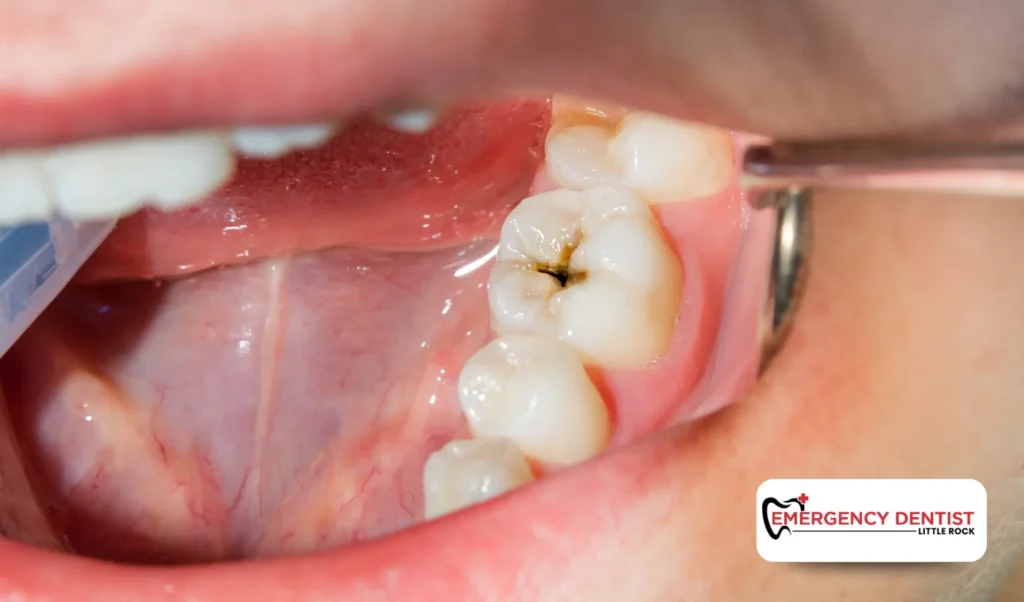 Common Causes of Dental Infections