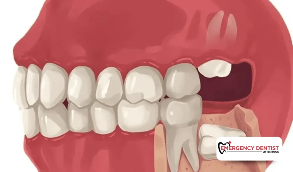 Why Holes Appear After Wisdom Teeth Removal
