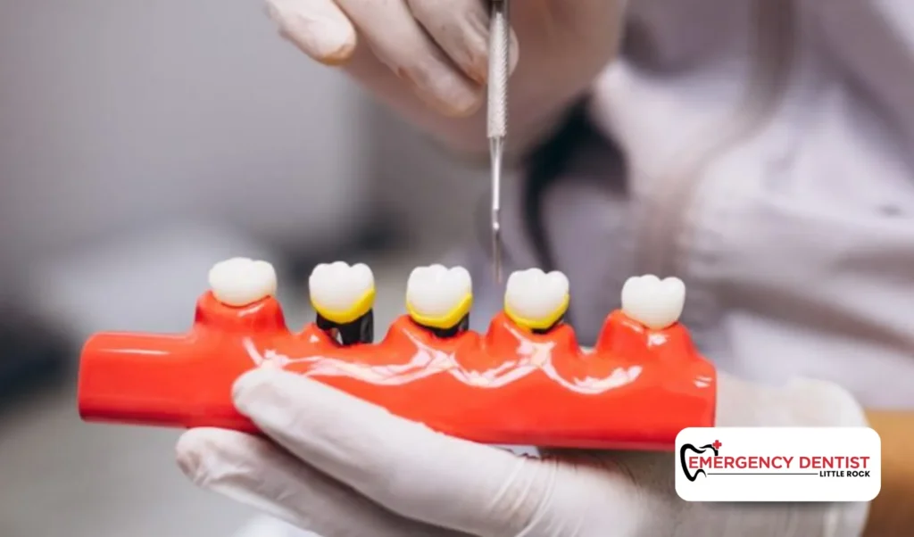 Why White Stuff Appears After Tooth Extraction