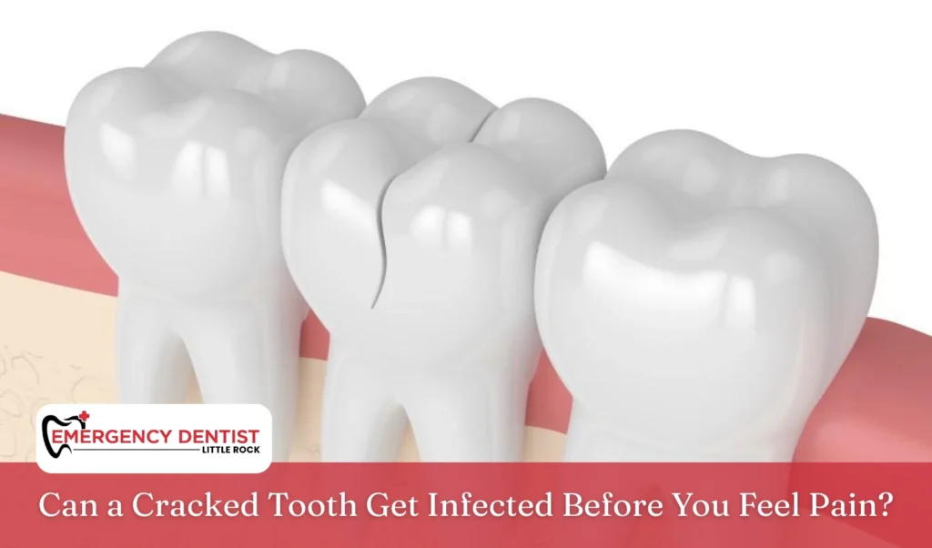 Can a Cracked Tooth Get Infected Before You Feel Pain