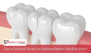 Can a Cracked Tooth Get Infected Before You Feel Pain