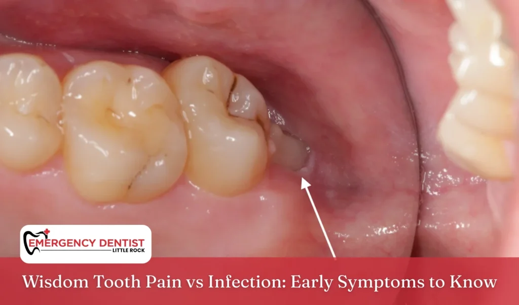 Wisdom Tooth Pain vs Infection Early Symptoms to Know