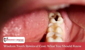 Wisdom Tooth Removal Cost What You Should Know
