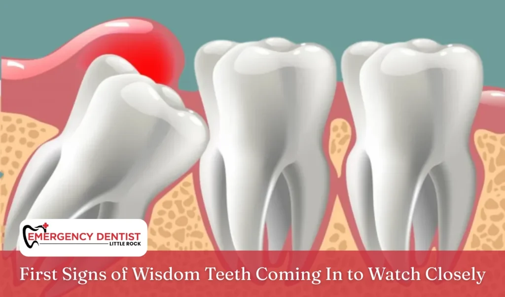 First Signs of Wisdom Teeth Coming In to Watch Closely