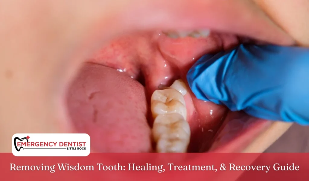 Removing Wisdom Tooth Healing, Treatment, & Recovery Guide