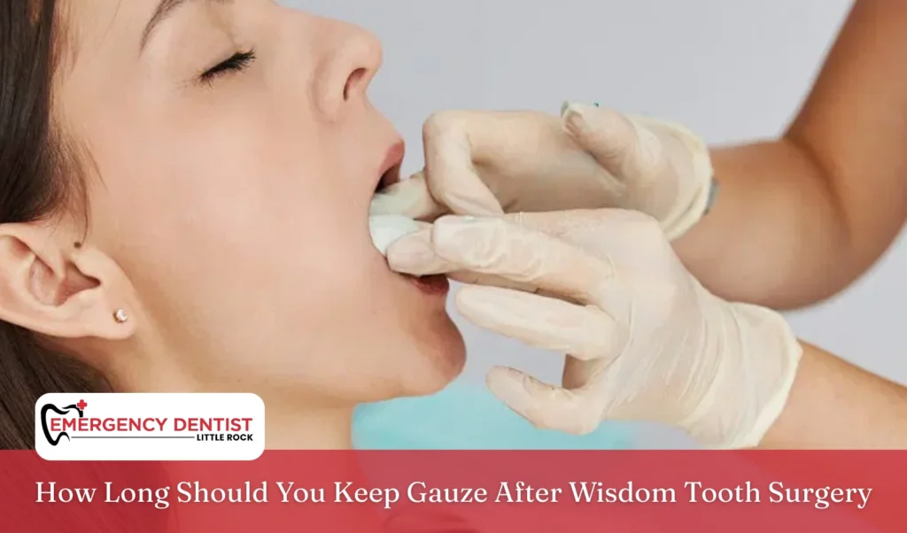 How Long Should You Keep Gauze After Wisdom Tooth Surgery