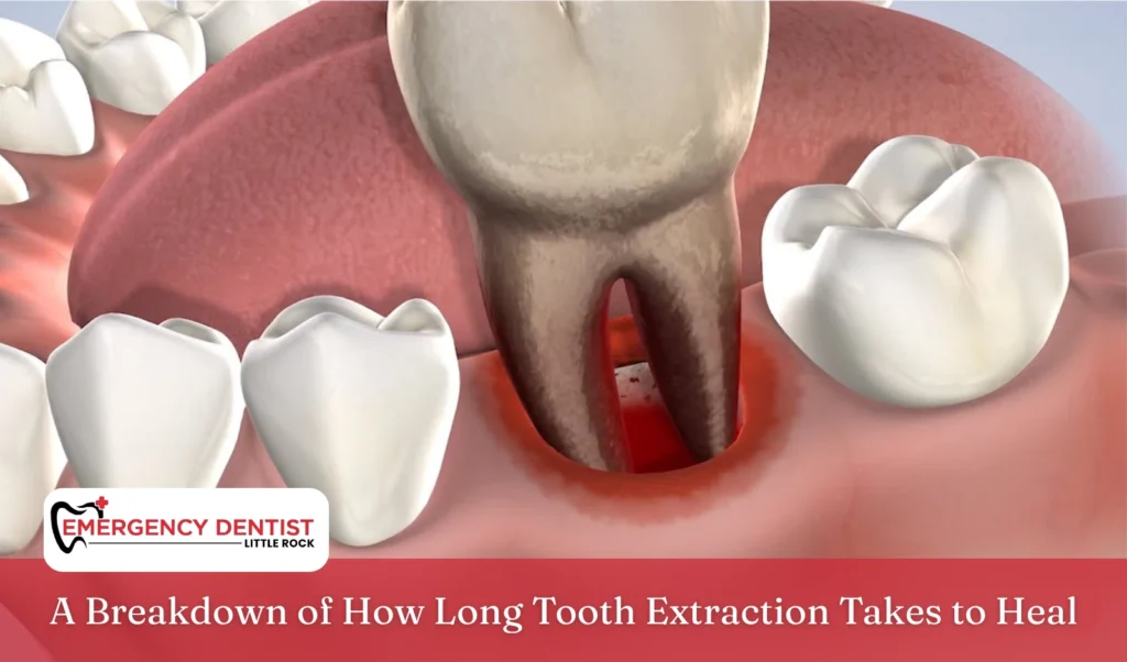 how-long-tooth-extraction-heal