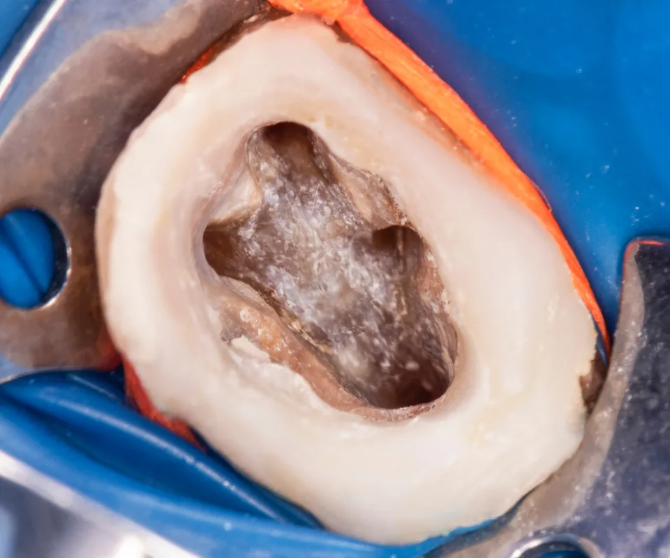 Cleaning-the-Root-Canal-Little-Rock-AR