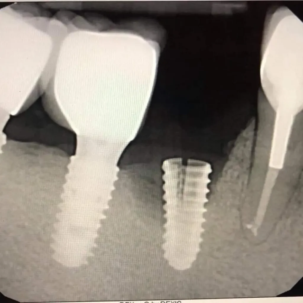 Cracked-or-fractured-implants-Little-Rock-AR