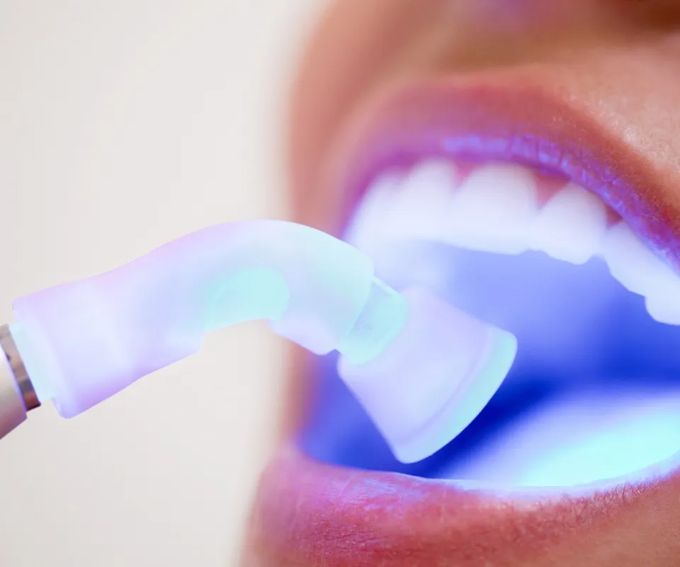 Dental-Bonding-or-Filling-Little-Rock-AR