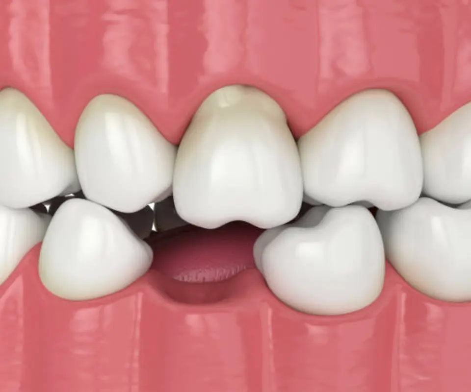 Dislocated-Teeth-Little-Rock-AR