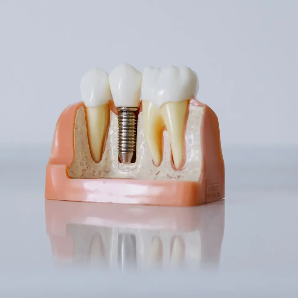 Emergency-Dental-Implant-Little-Rock-AR