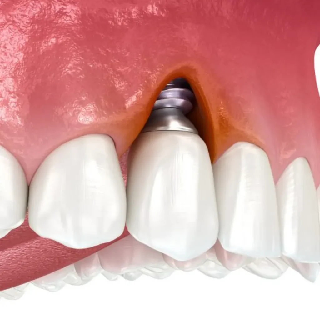 Infection-or-pain-around-an-implant-Little-Rock-AR