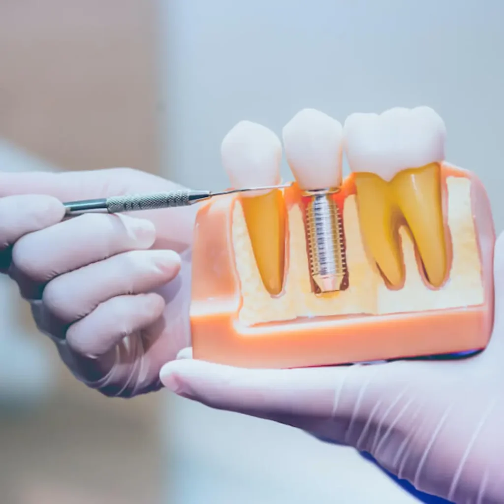 Loose-or-shifting-dental-implants-Little-Rock-AR