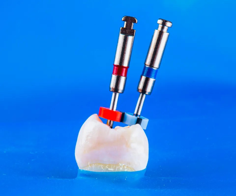 Root-Canal-Treatment-Little-Rock-AR