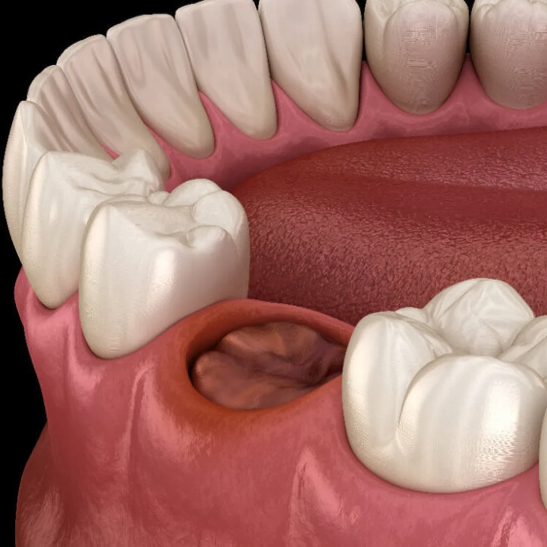 Symptoms-of-Dry-Socket-Little-Rock-AR