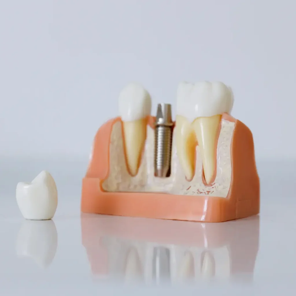 The-implant-crown-fell-off-or-broke-Little-Rock-AR