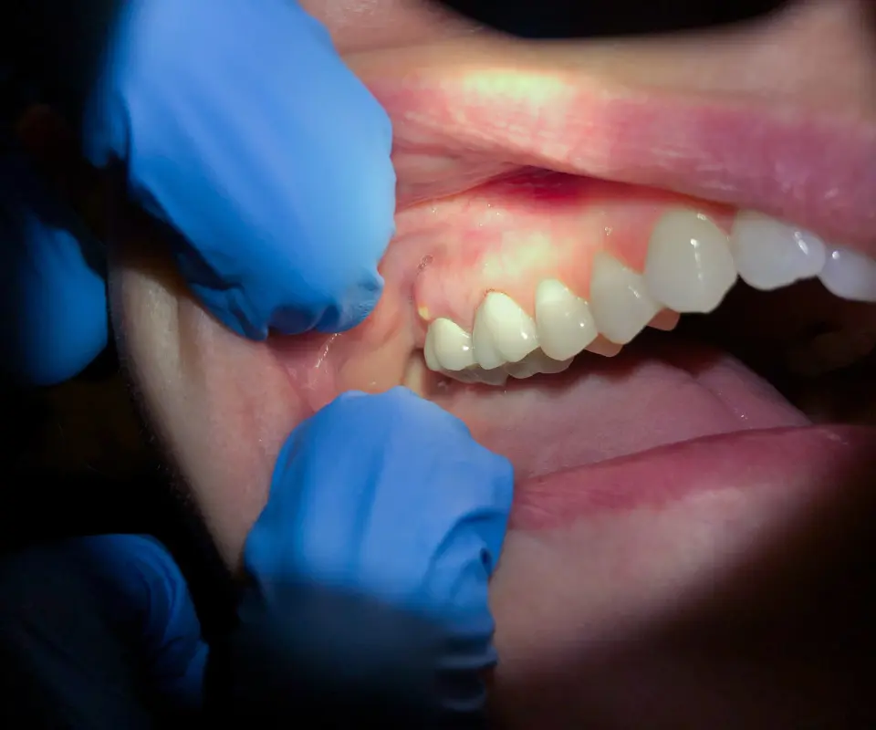 Tooth-Abscess-Little-Rock-AR