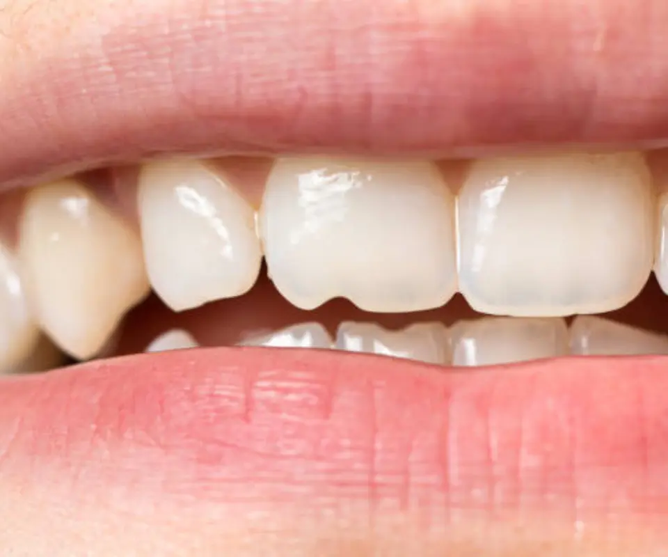 Tooth-Fractures-Little-Rock-AR