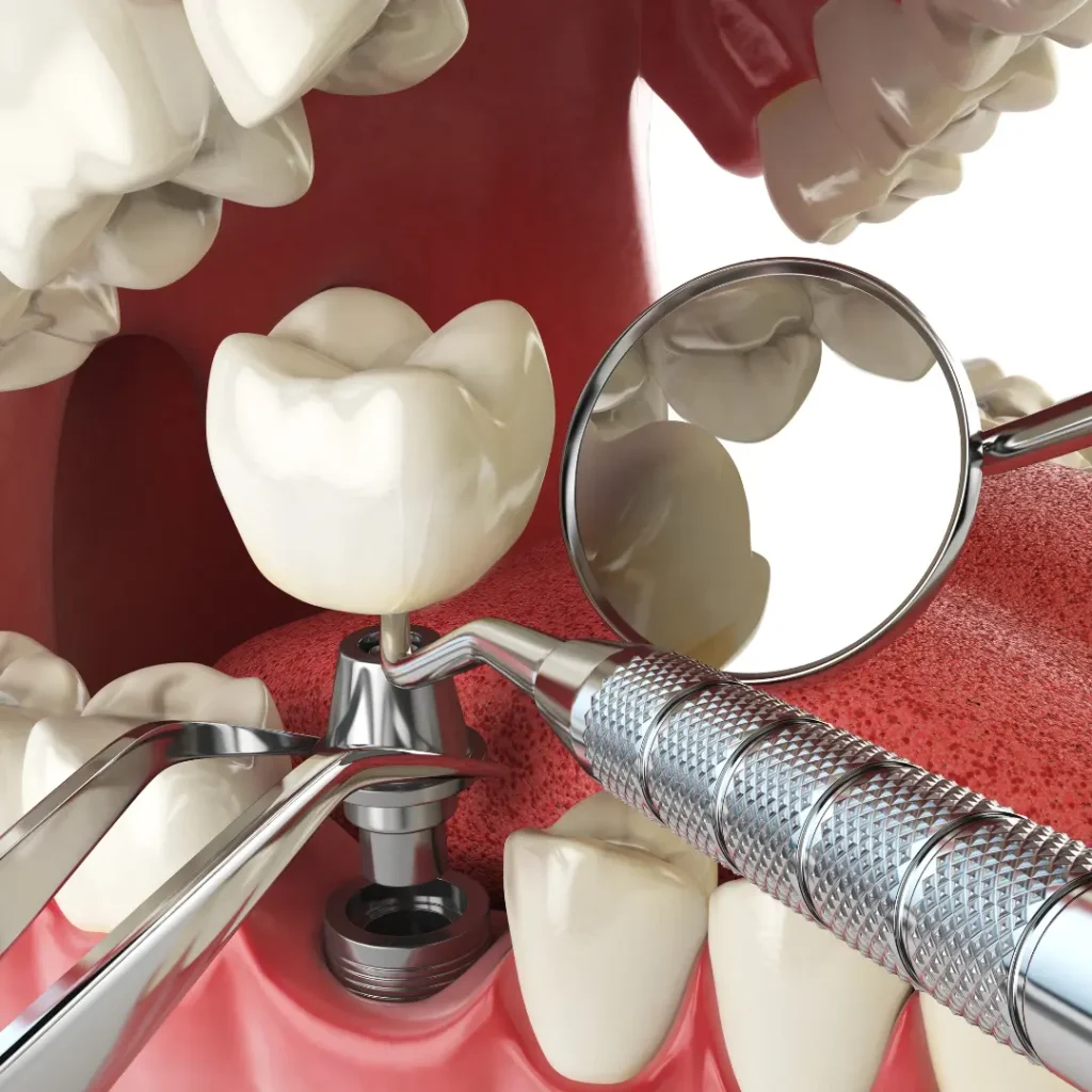 Trauma-related-tooth-loss-needs-immediate-implants-Little-Rock-AR