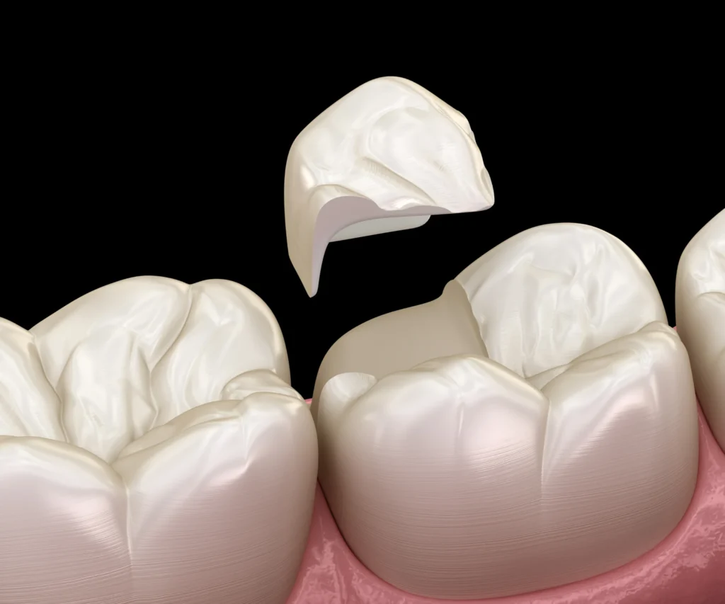 What-Causes-a-Cracked-Tooth-Little-Rock-AR