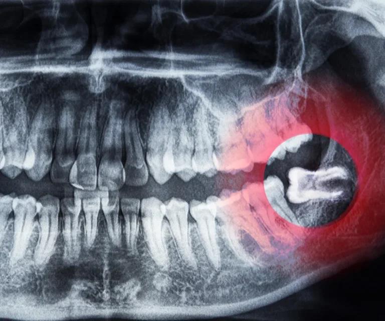 Wisdom-Tooth-Infection-Emergencies-Little-Rock-AR