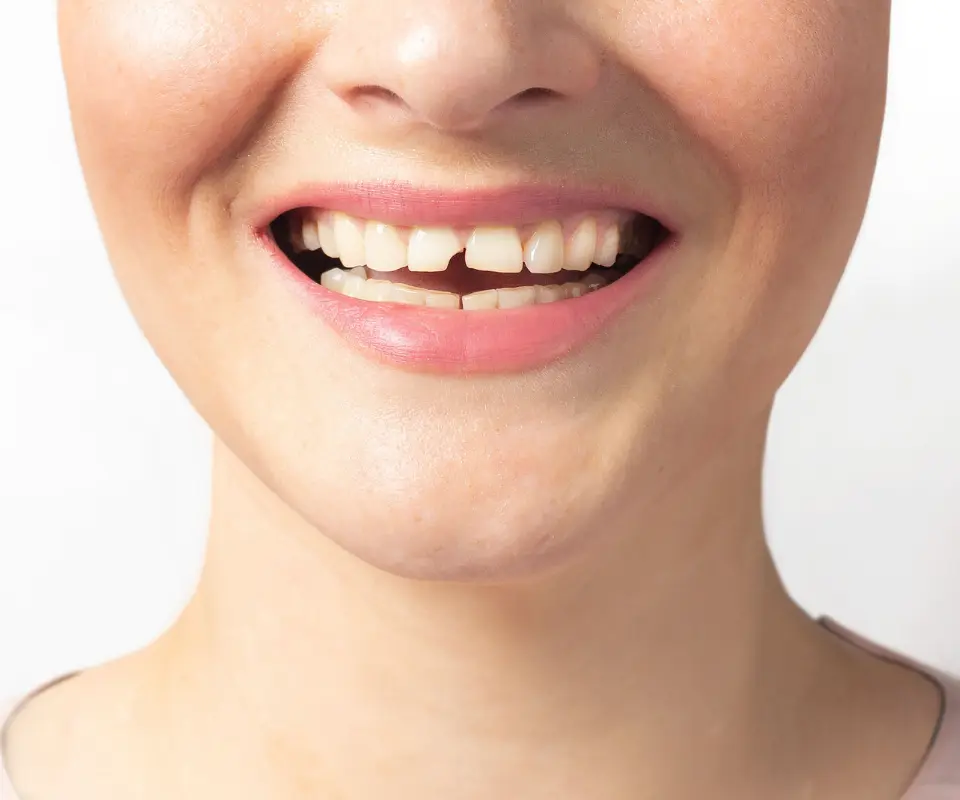 Cracked-or-Broken-Teeth-Little-Rock-AR
