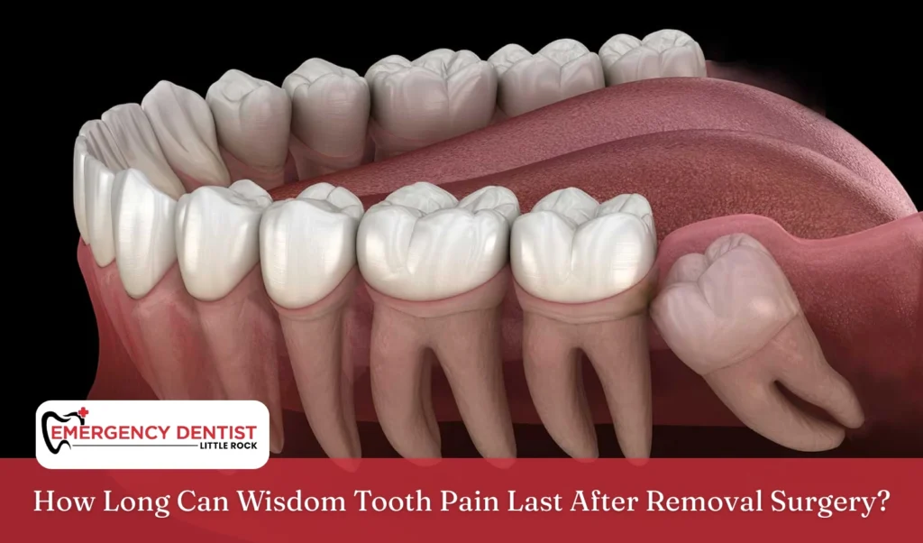 how-long-wisdom-tooth-pain-lasts-after-removal-surgery