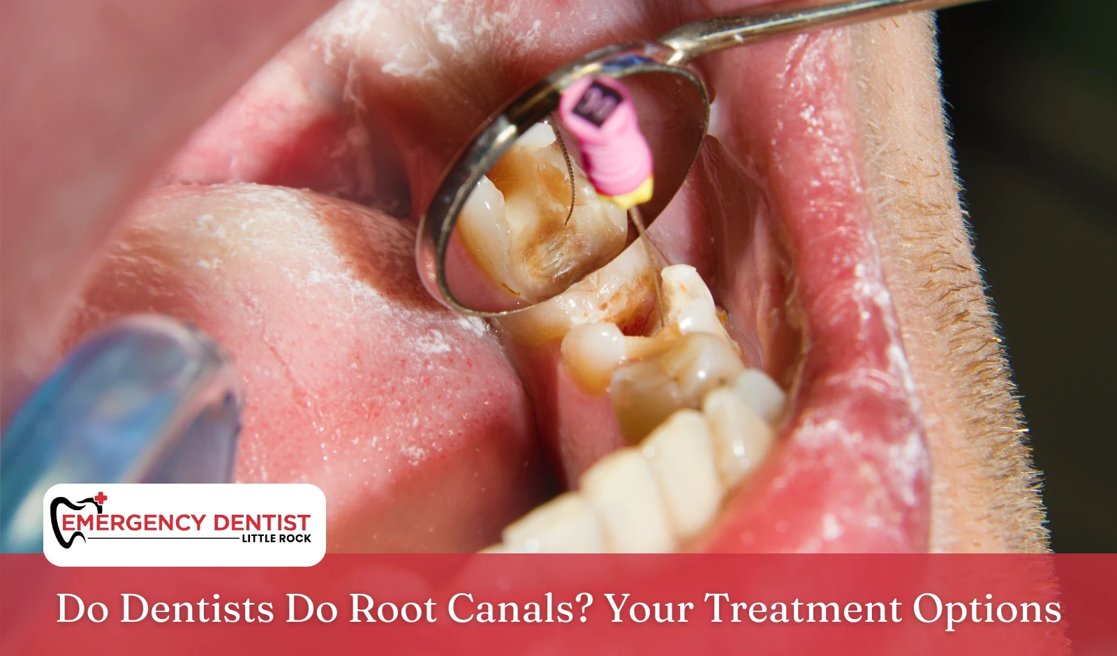 do-dentists-do-root-canals-treatment-options