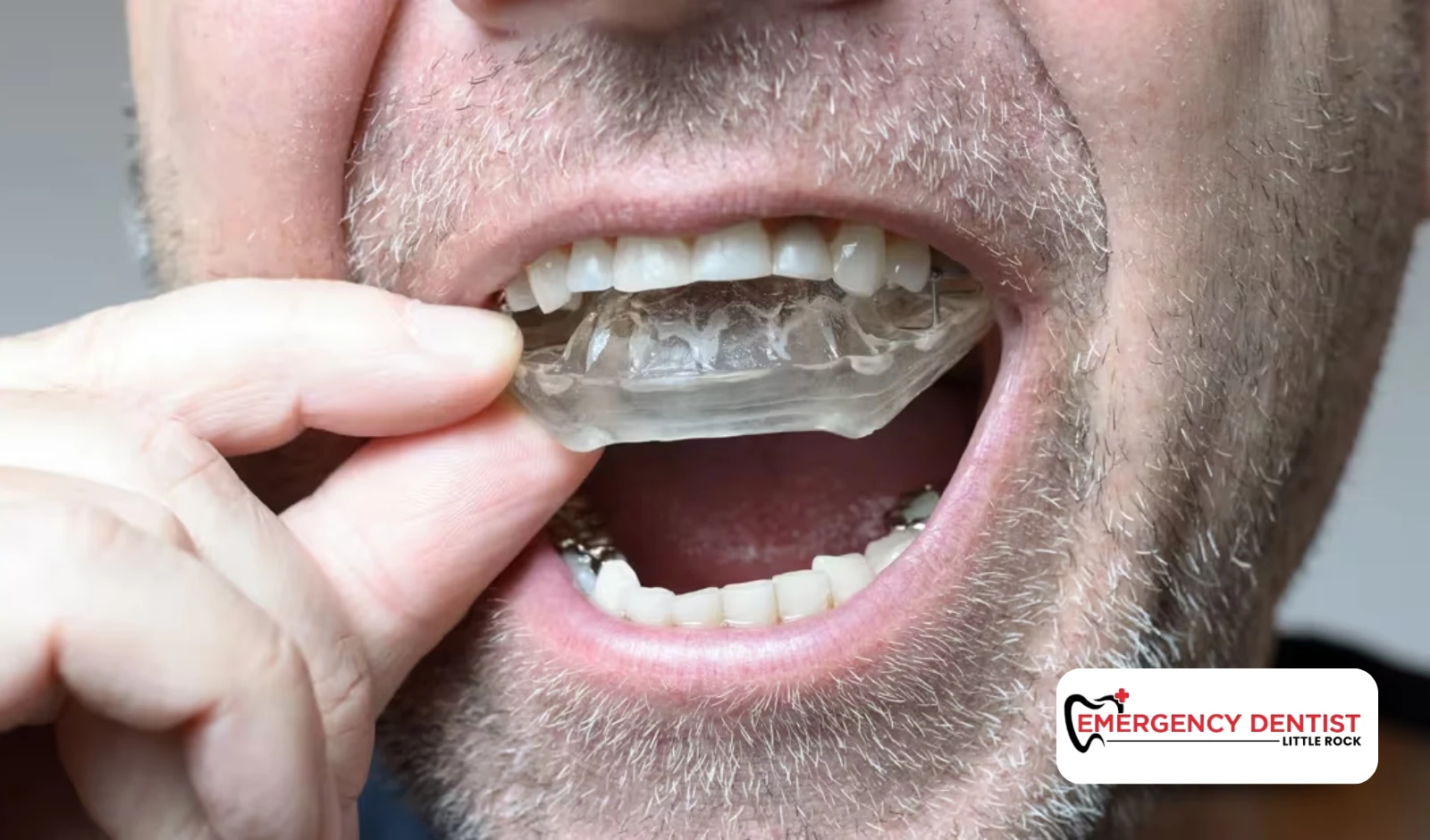 How Does a Sports Mouthguard Provide Protection