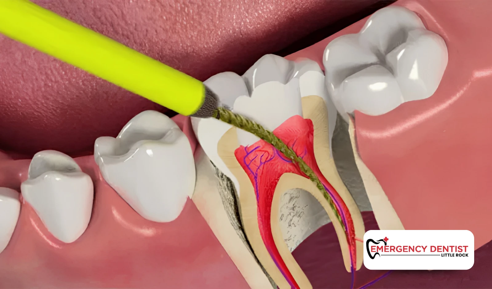 What Factors Affect the Cost of a Root Canal?