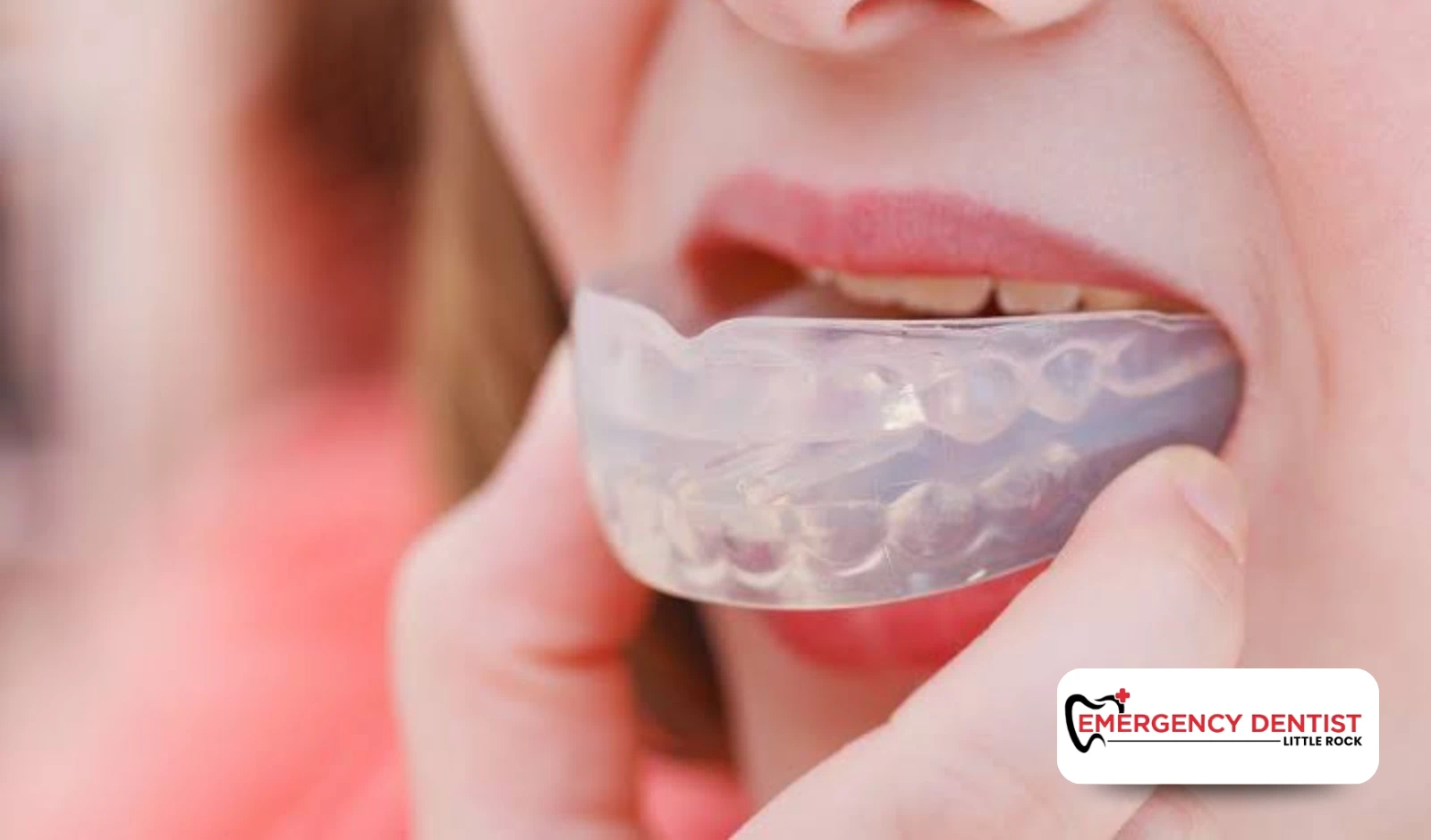 Why Mouthguards Are Important for Athletes
