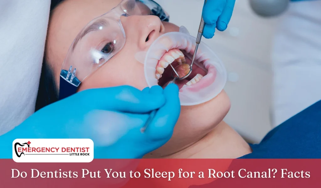 Do Dentists Put You to Sleep for a Root Canal Facts