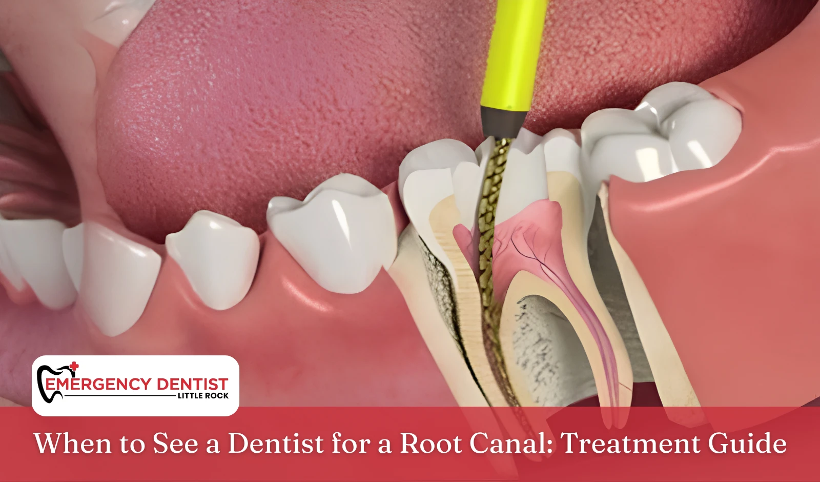 When to See a Dentist for a Root Canal Treatment Guide